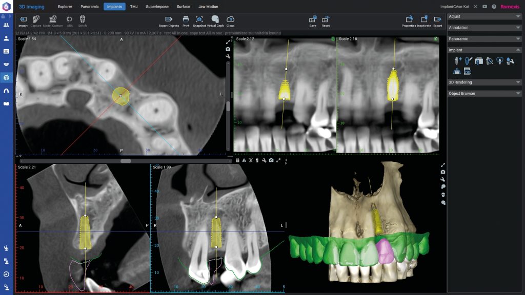 Implantati