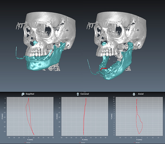 4D Jaw Motion