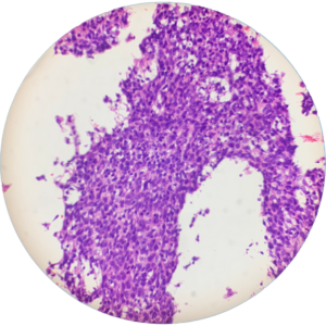 Head Neck Mass - Cell Block