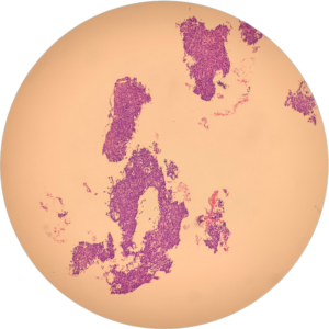Head Neck Mass - Cell Block