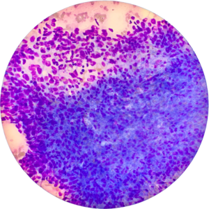 Head Neck Mass - Diff Quick Stain