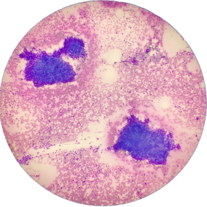 Head Neck Mass - Diff Quik Stain