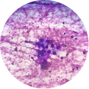 Lung - Diff Quik Stain