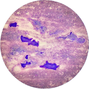 Lymph Node - Diff Quik Stain