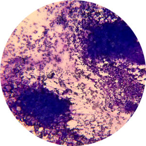 Lymph Node - Diff Quik Stain
