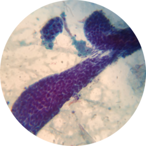 Parotid - Diff Quik Stain
